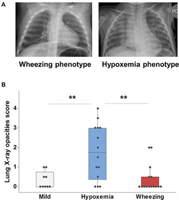 Phenotypical Sub-setting of the First Episode of Severe Viral Respiratory Infection Based on Clinical Assessment and Underlying Airway Disease: A Pilot Study